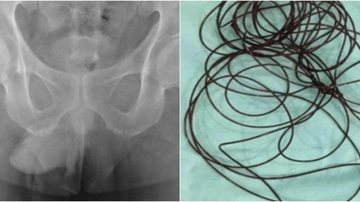 Homem insere fio no pênis e termina no hospital Fio de nylon na uretra - Reprodução/Radiology Case Reports