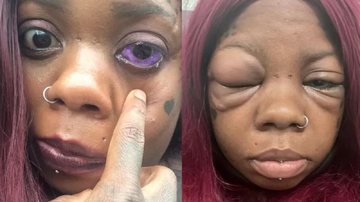 Anaya divulgou seu caso nas redes sociais onde recebeu mensagens de apoio e críticas pela tatuagem Tatuagem no globo ocular Mulher com o olho inchado e tatuagem no globo ocular - Reprodução/Rede Social